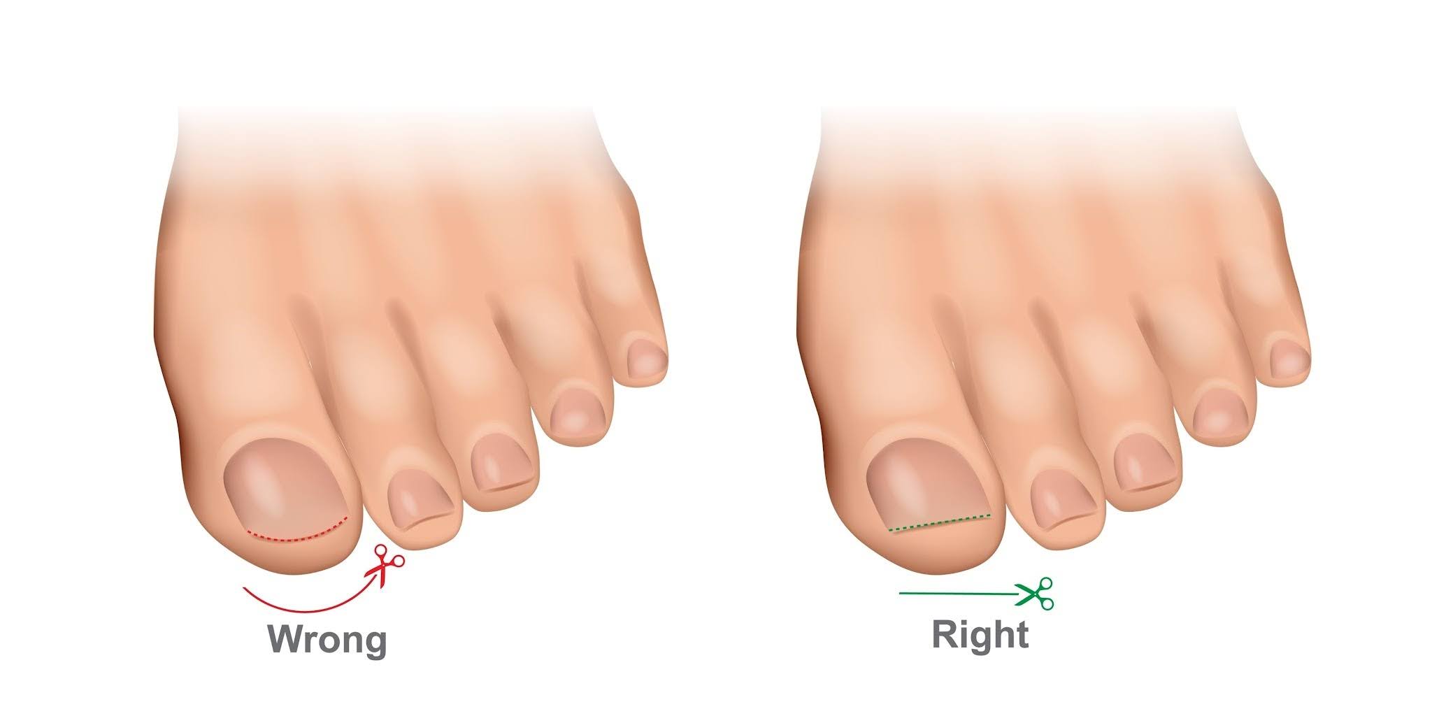 teennagels-correct-knipen