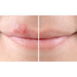 Sorefix Duo Koortslip Patch - 9.95 euro