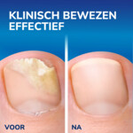 Dr. Scholl's Kalknagel 2-in-1 Behandel & Beschermset - 14.99 euro