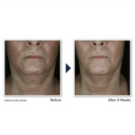 RoC Derm Correxion Contour Cream - 38.49 euro