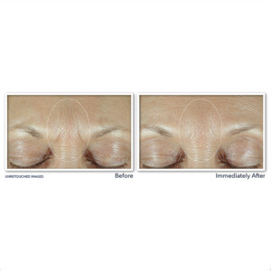 RoC Derm Correxion Fill+ Treat Serum - 29.49 euro