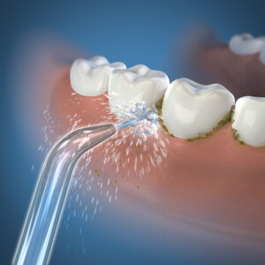 5x Waterpik Classic Jet Tips JT-100E 2022 - 43.39 euro