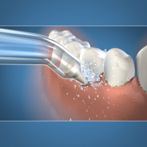 Waterpik Pik Pocket Tips PP-100E - 8.85 euro