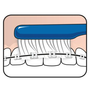 TePe Implantaat en Orthodontieborstel - 2.35 euro